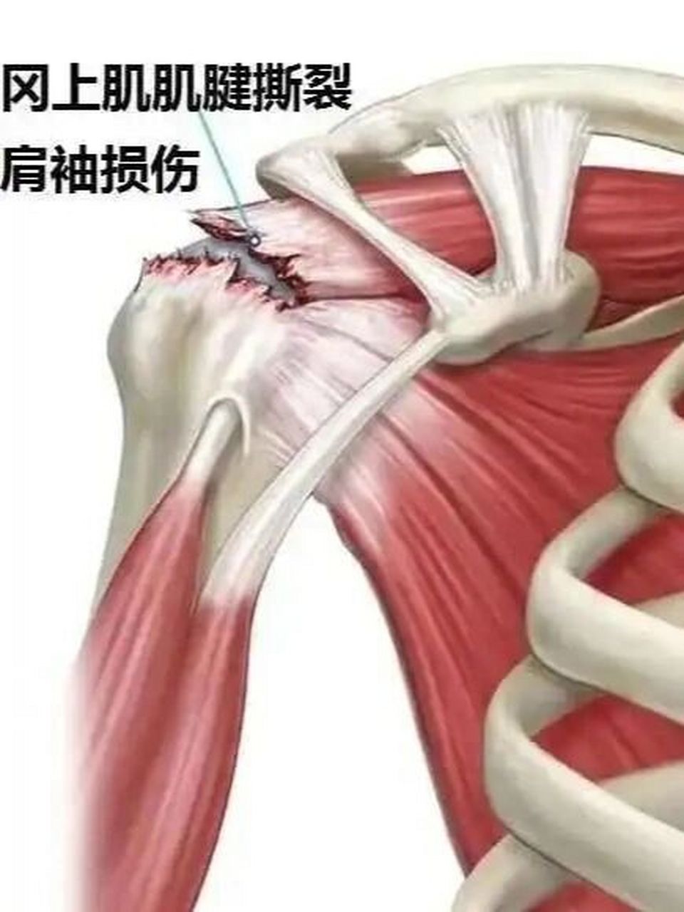 三角肌,斜方肌,搭配红外线,超声波仪器等帮助我们减轻炎症,缓解疼痛