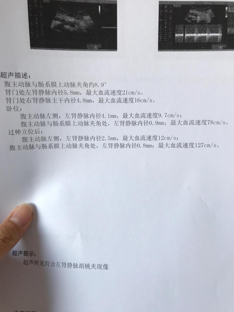 胡桃夹综合征超声诊断图片