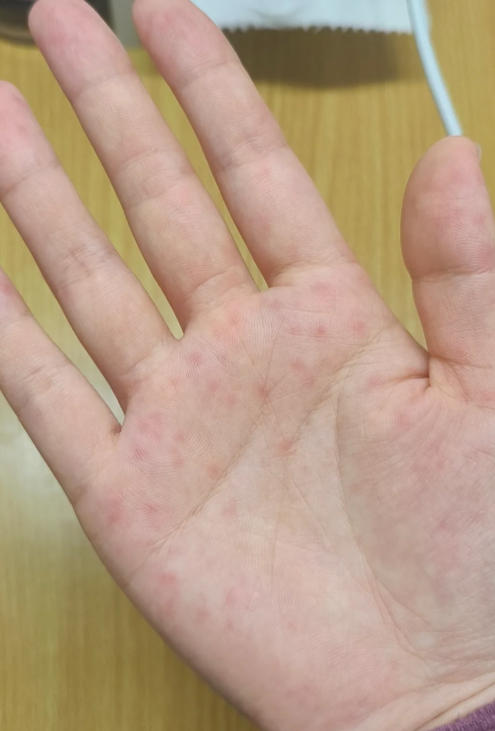 如果红点伴随瘙痒,很可能是过敏引起的