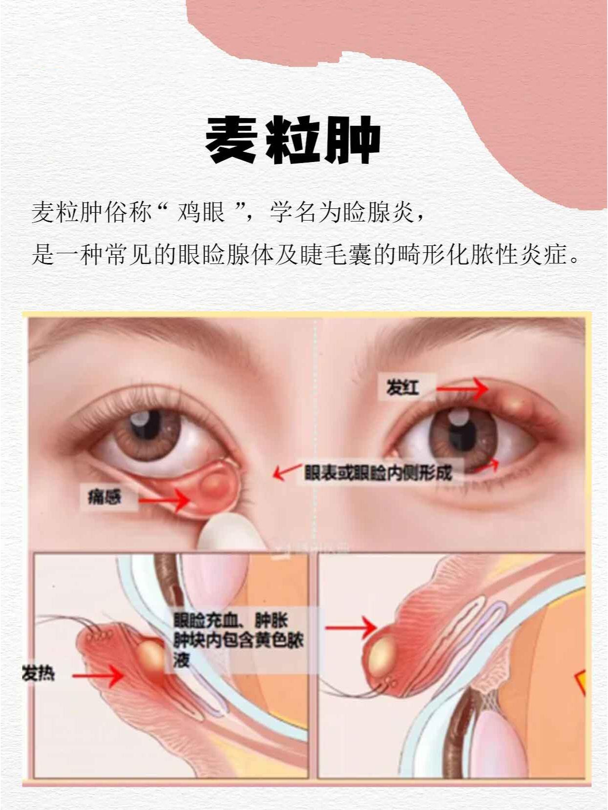 麦粒肿包扎图片