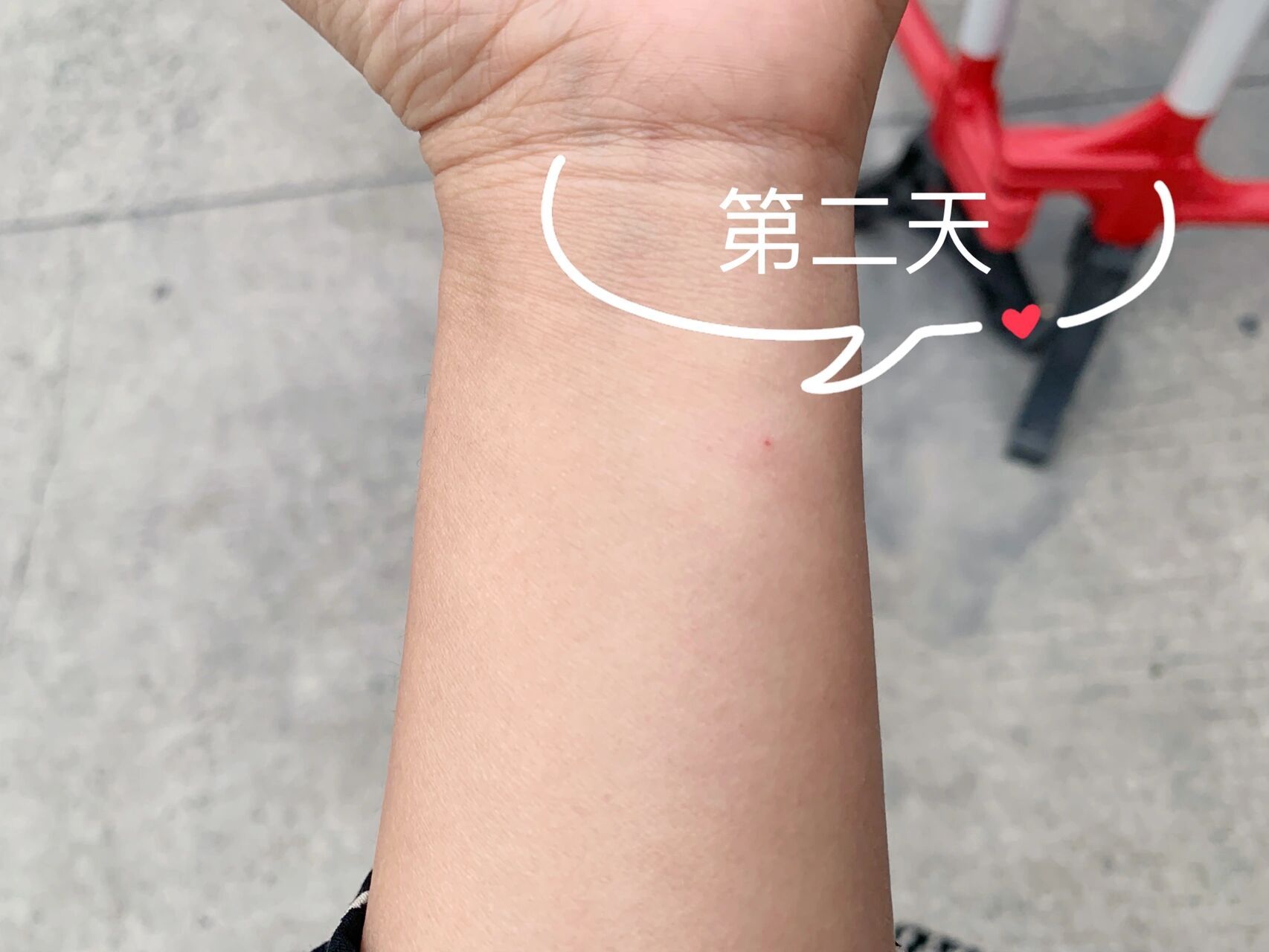 中六试管之ppd皮试 ppd是结核菌素试验,是在临床中诊断结核病的一项