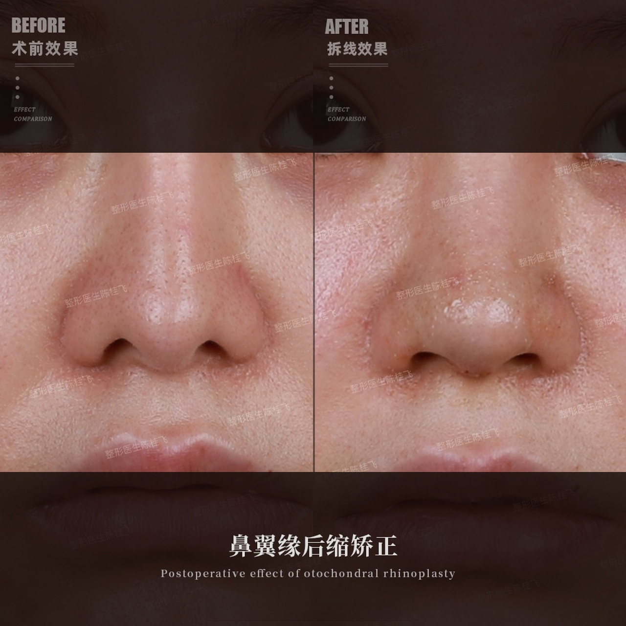 给大家分享几组有做鼻翼缘后缩矫正的案例 最后一张是朝天鼻,挛缩鼻