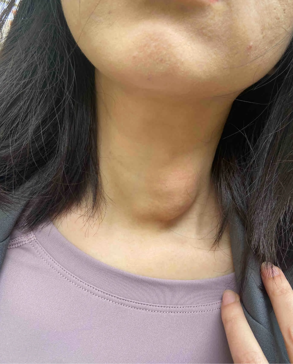 甲状腺结节的早期症状因人而异,有些患者可能没有明显表现