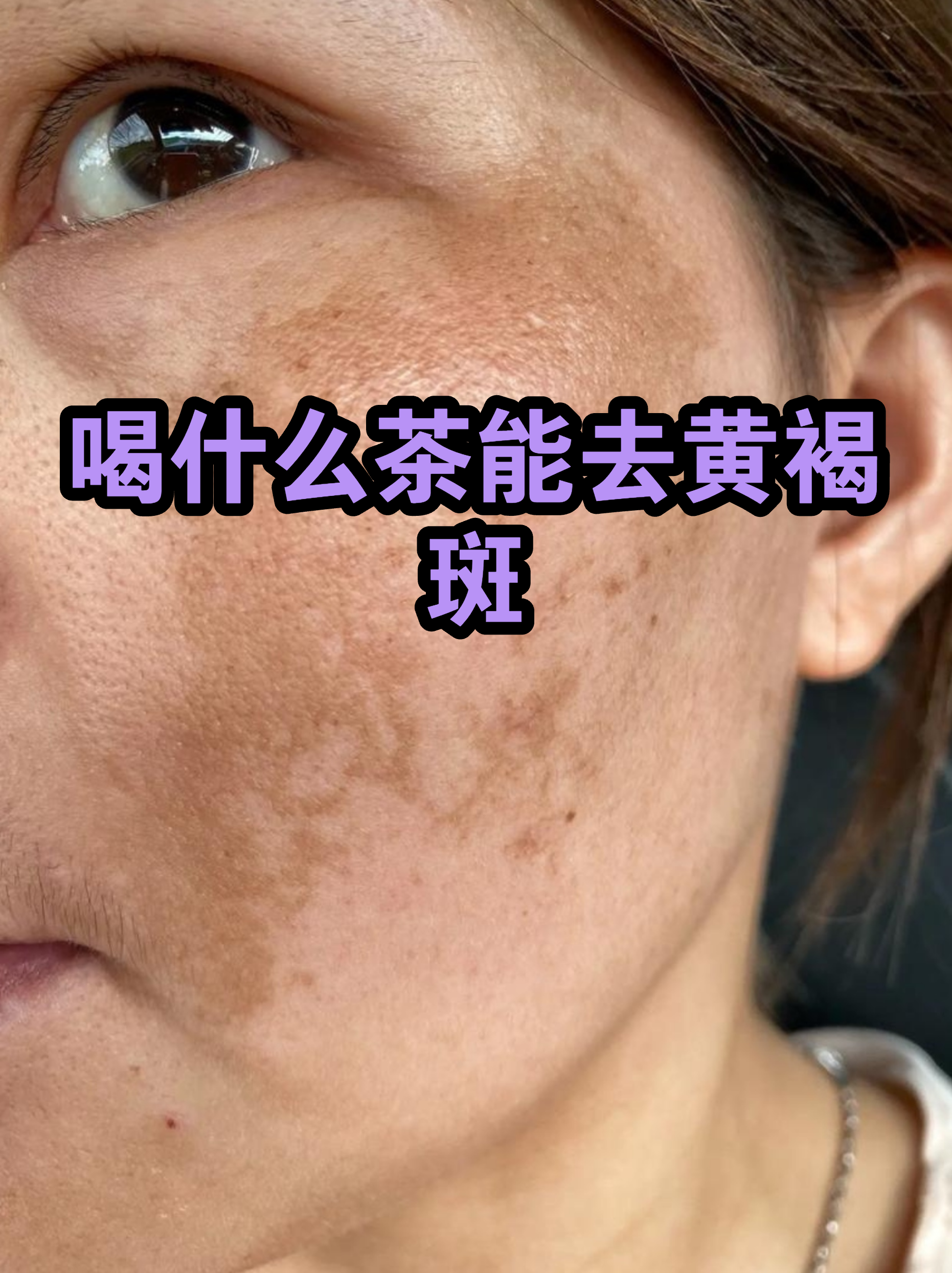 脸上长黄褐斑看什么科最好(脸上长黄褐斑看什么科最好呢)