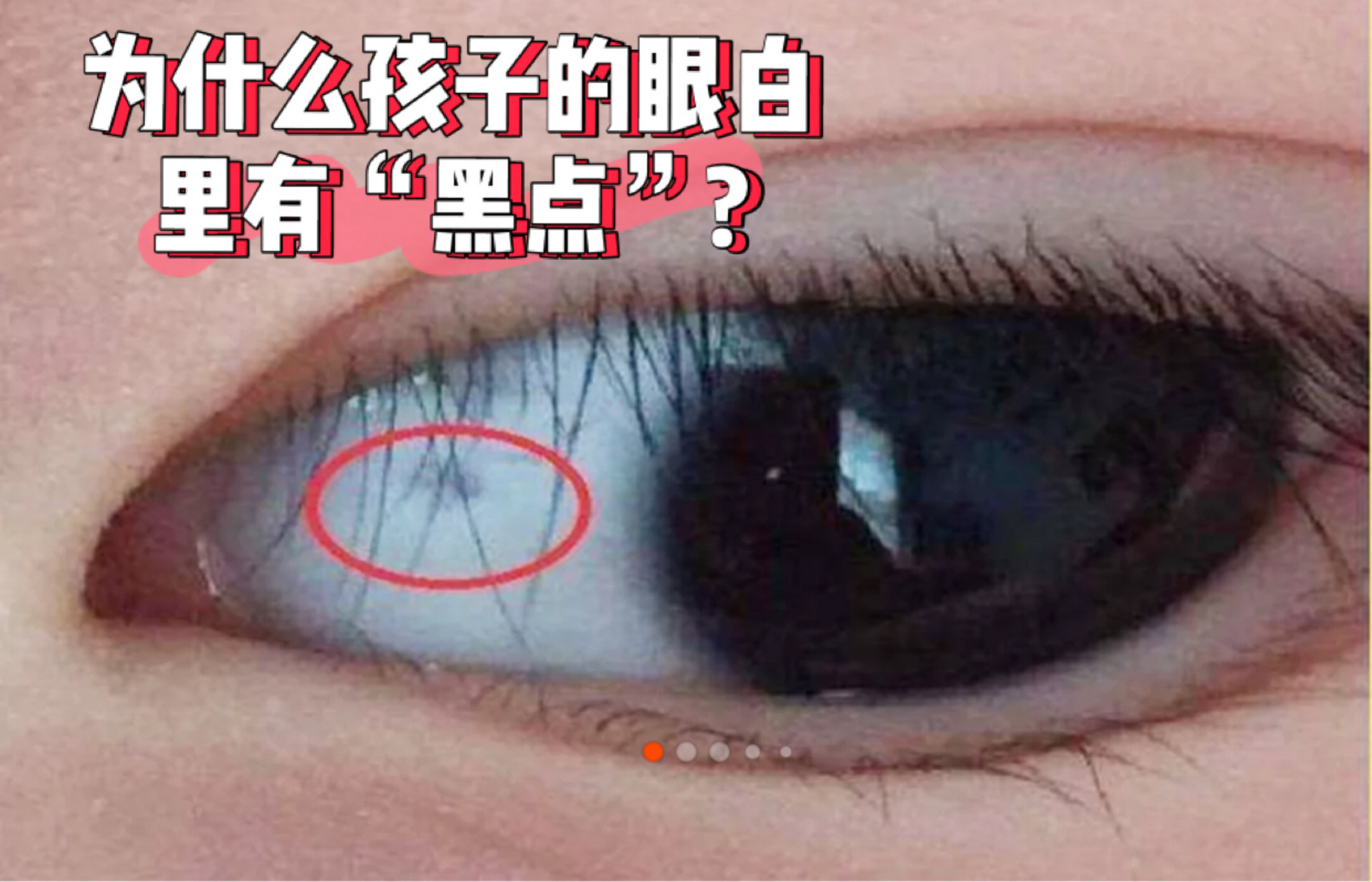 为什么孩子的眼白里有"黑点"? 属于正常情况,不必紧张