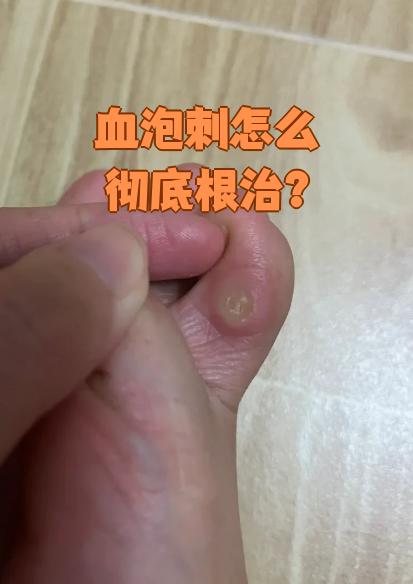 血泡刺就是鸡眼,想彻底治好它主要有三种方法:一般治疗,药物治疗和