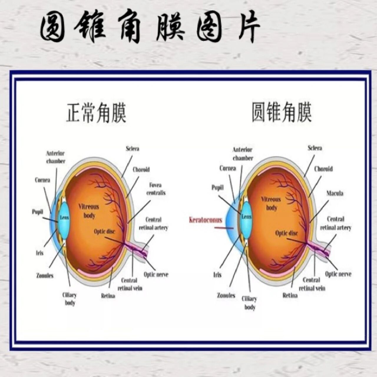 圆锥角膜图图片