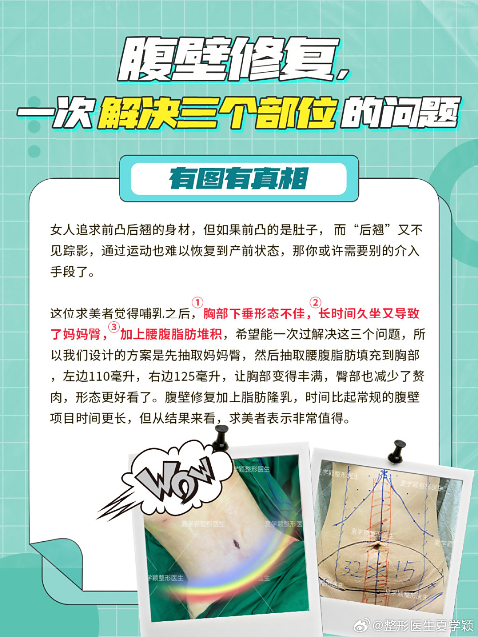 腹壁修复,一次解决三个部位的问题#腹壁整形##腹壁成型术