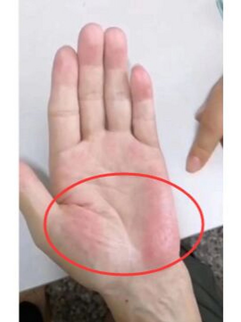 身体也挺好的,没有任何不适的症状,可从年初开始,就出现手掌发红的
