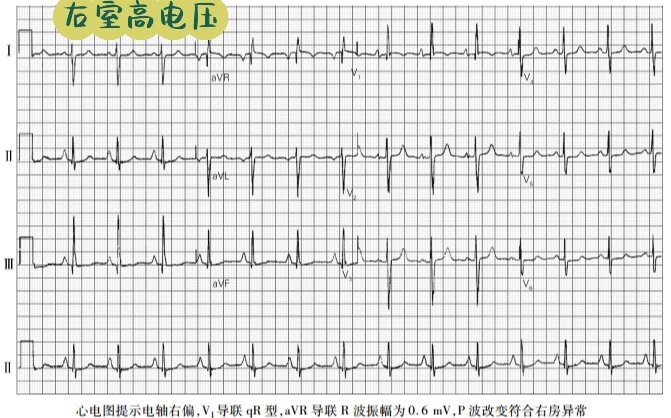 左心室肥大的心电图图片