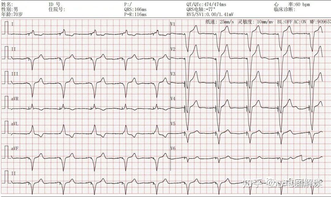 心室起搏心电图特点图片