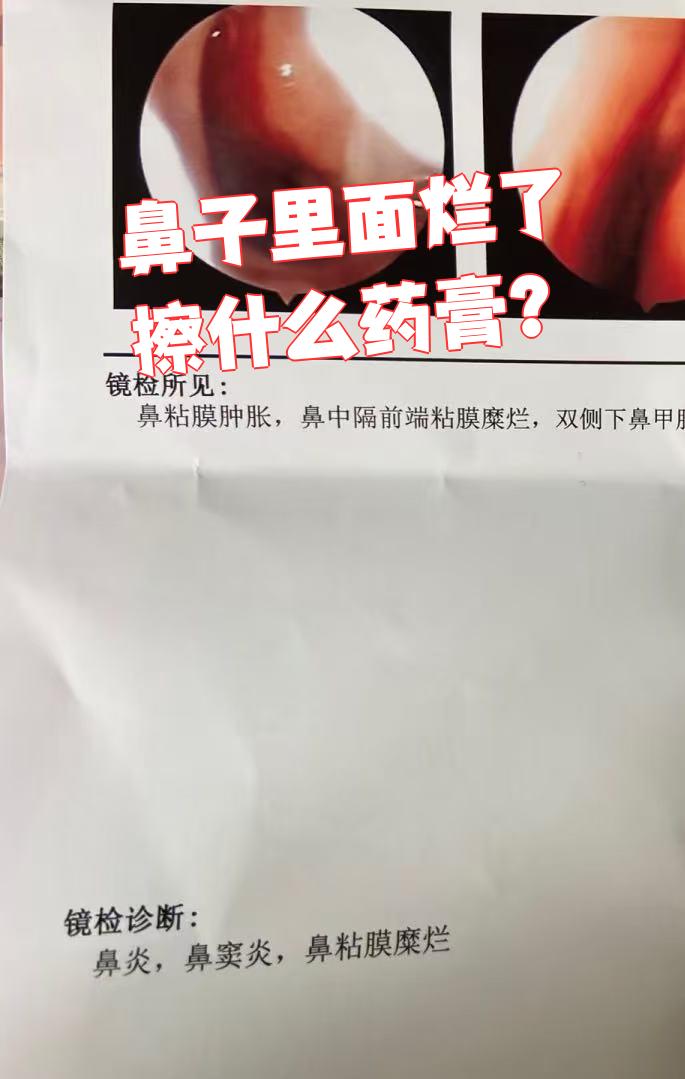 鼻子里面烂了可以擦金霉素眼膏或红霉素眼膏