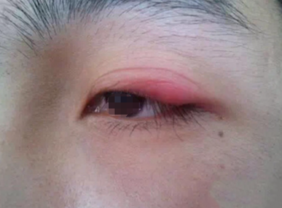 主要症状是眼皮红肿,发热和疼痛