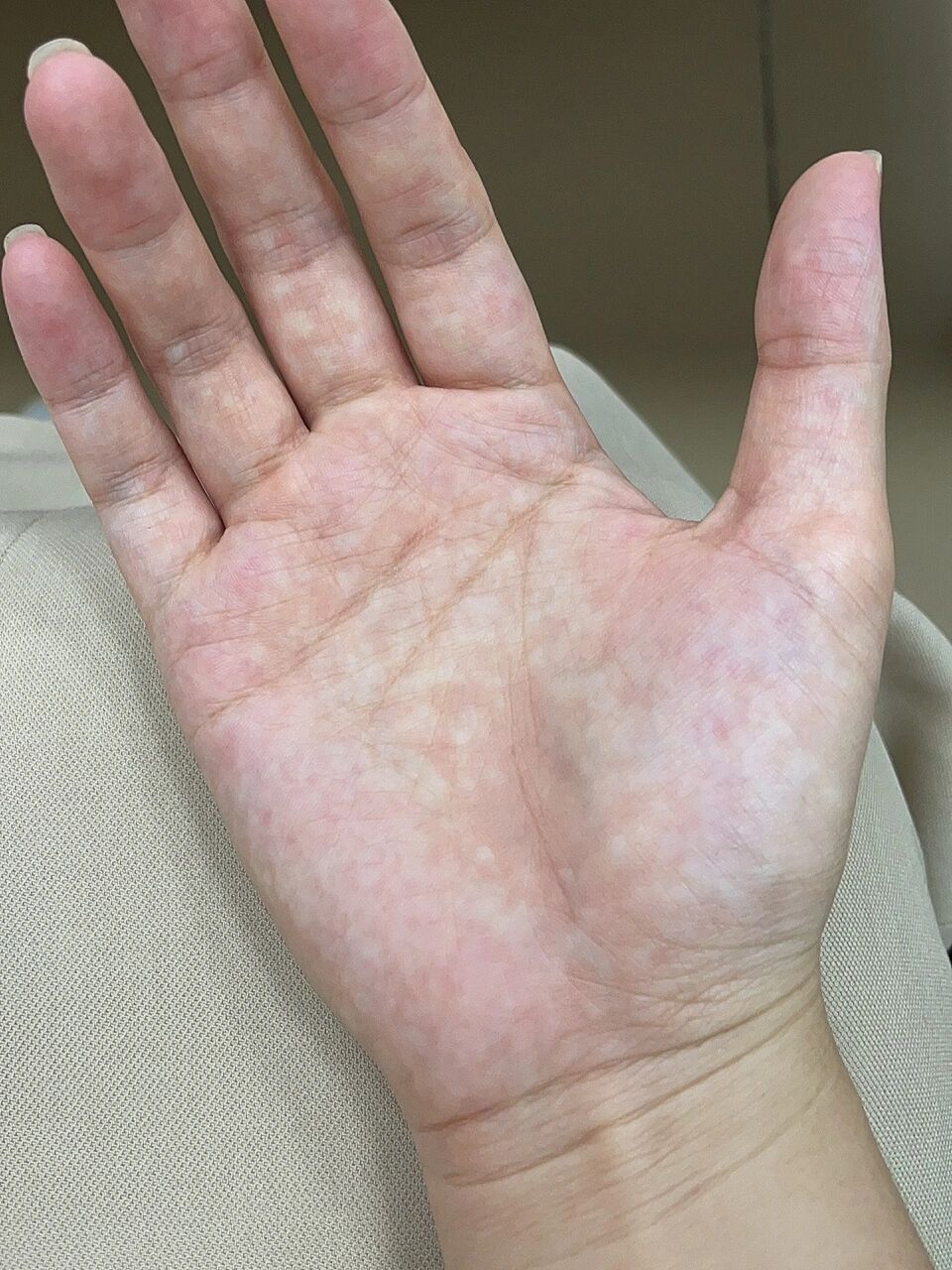 手掌纹路 手掌的纹路好多红点点白点点也好多 这样子正常吗