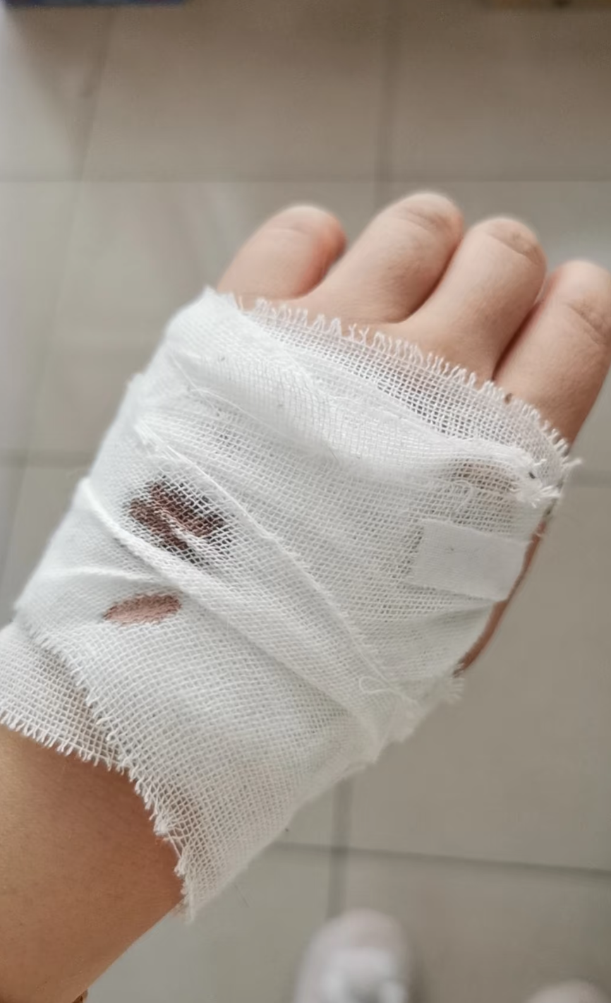 不换的话容易长细菌,伤口可能再次感染,这样会更麻烦