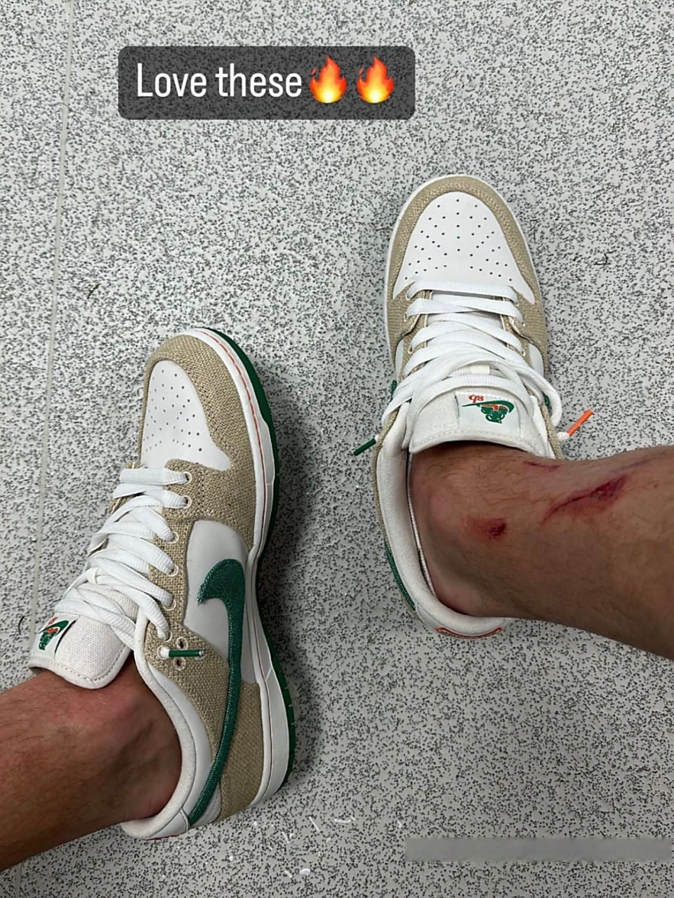 哈兰德赛后展示腿上的伤口:我爱这些!