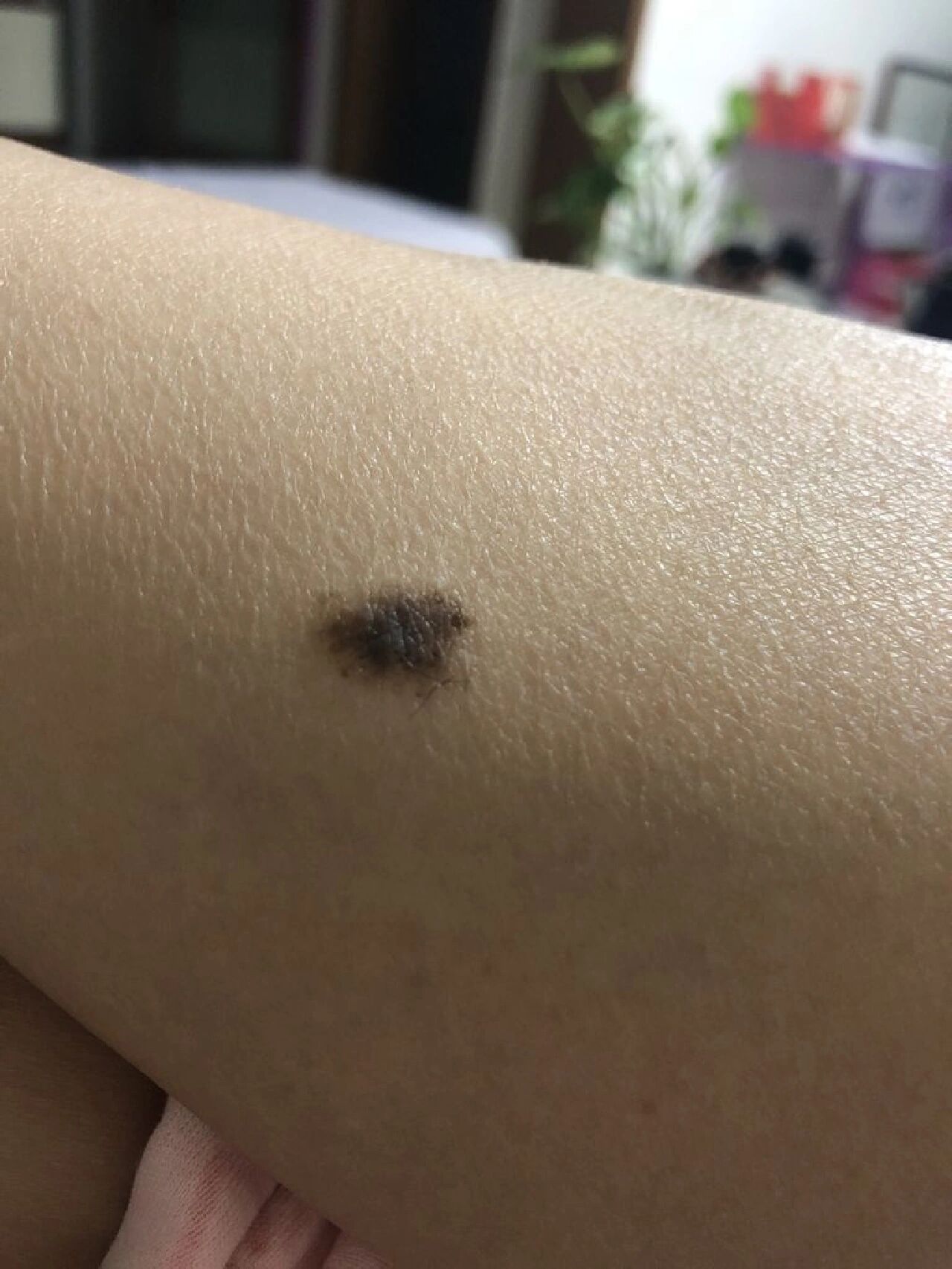 痣癌变前有哪些症状(二) 93直径增大 正常的痣一般在5毫米以内.