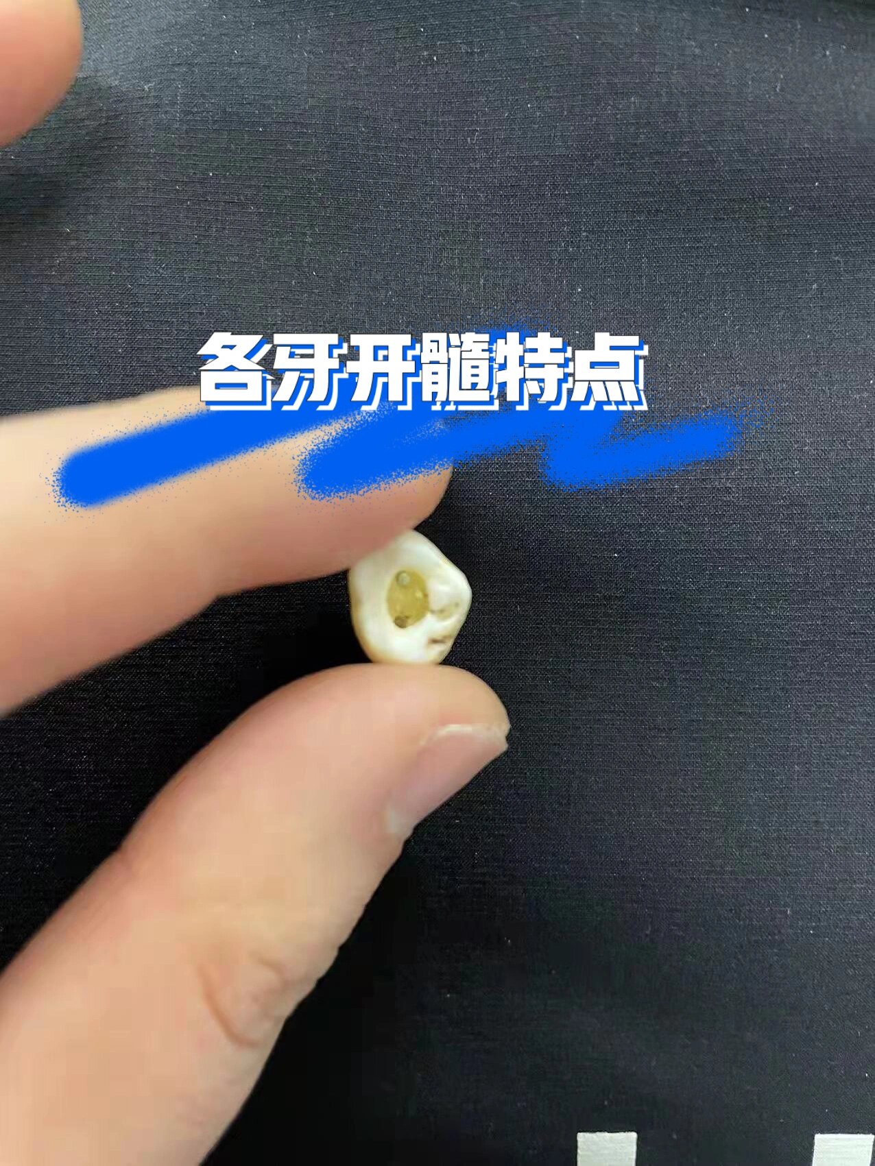 各牙开髓形态及髓腔解剖特点