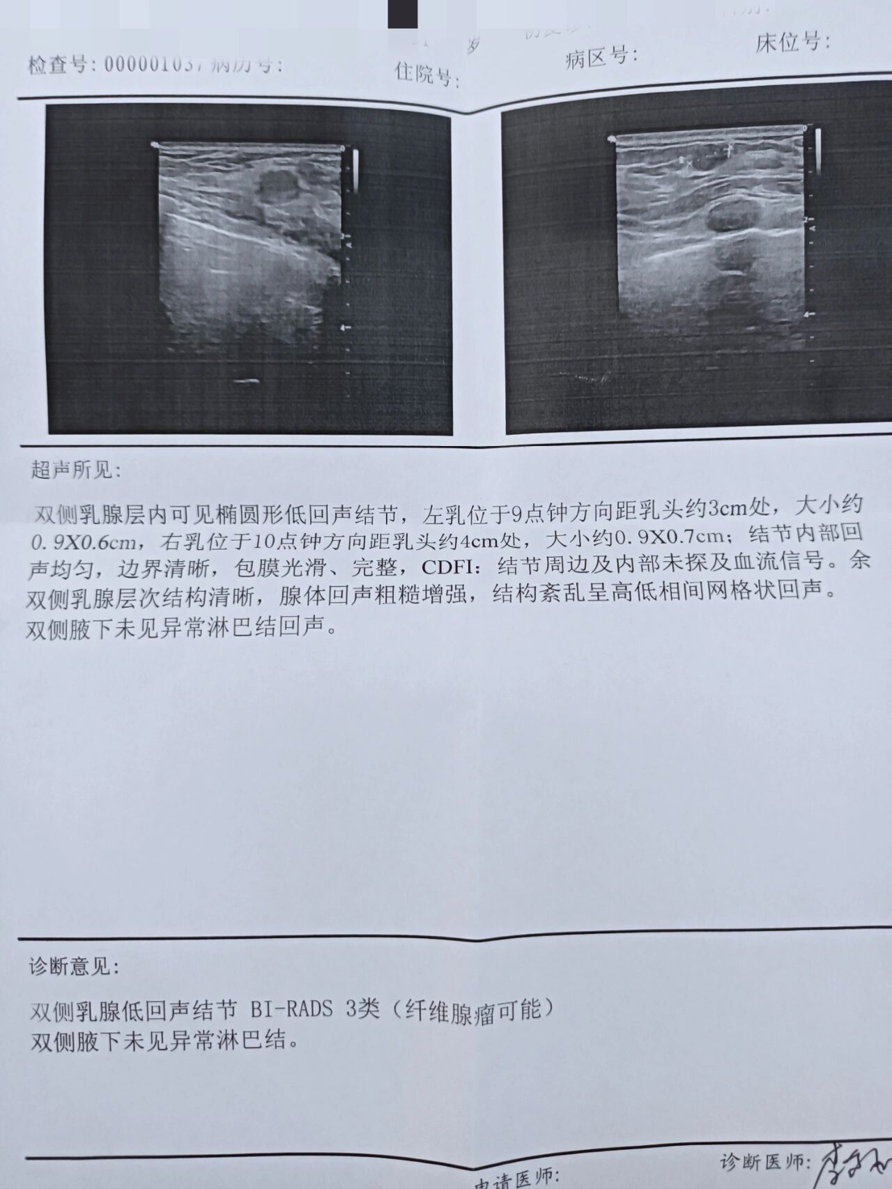 乳腺结节4a