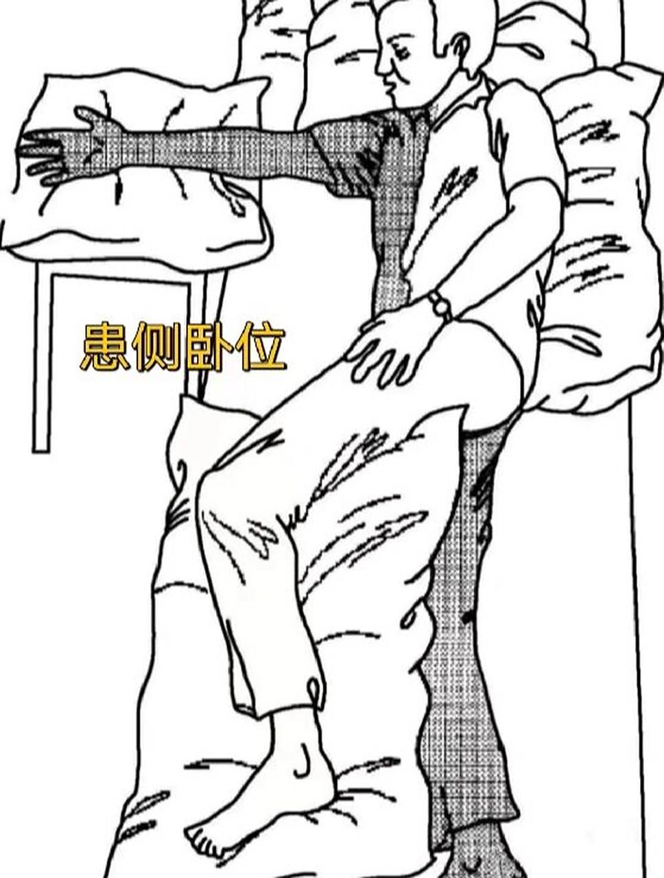 良肢位摆放 患侧卧位