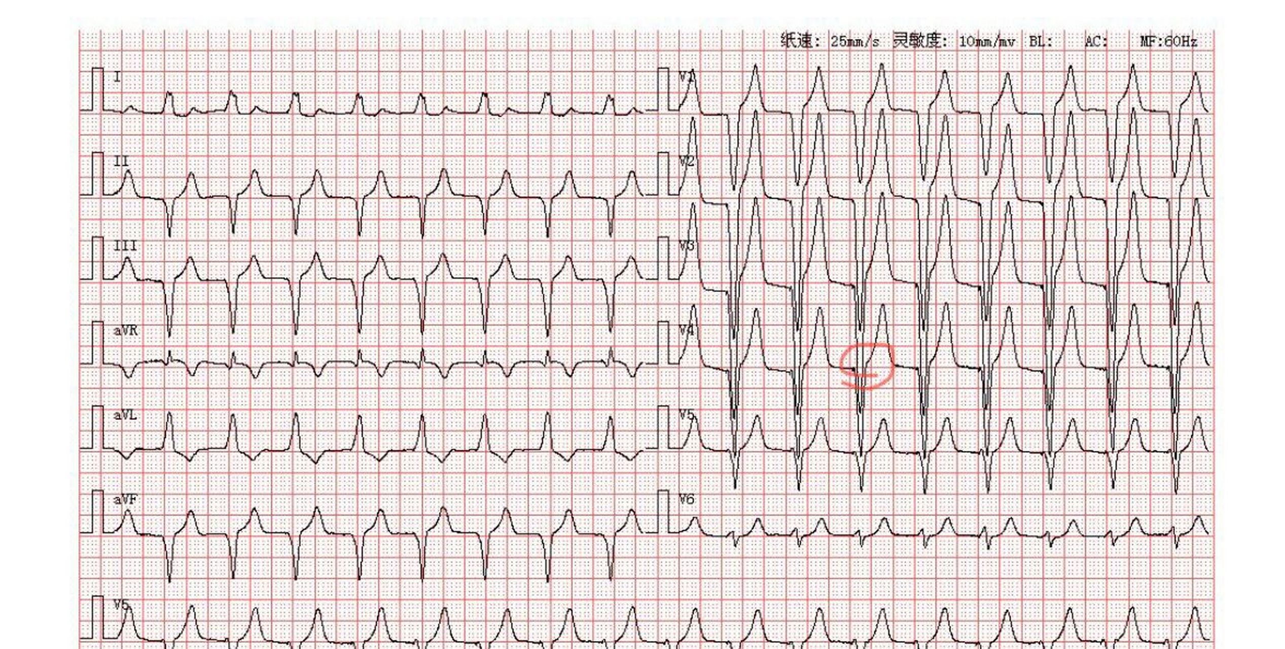 心电图:右心室起搏心律 总结:右心室起搏心律 	 分析:如图中标志的