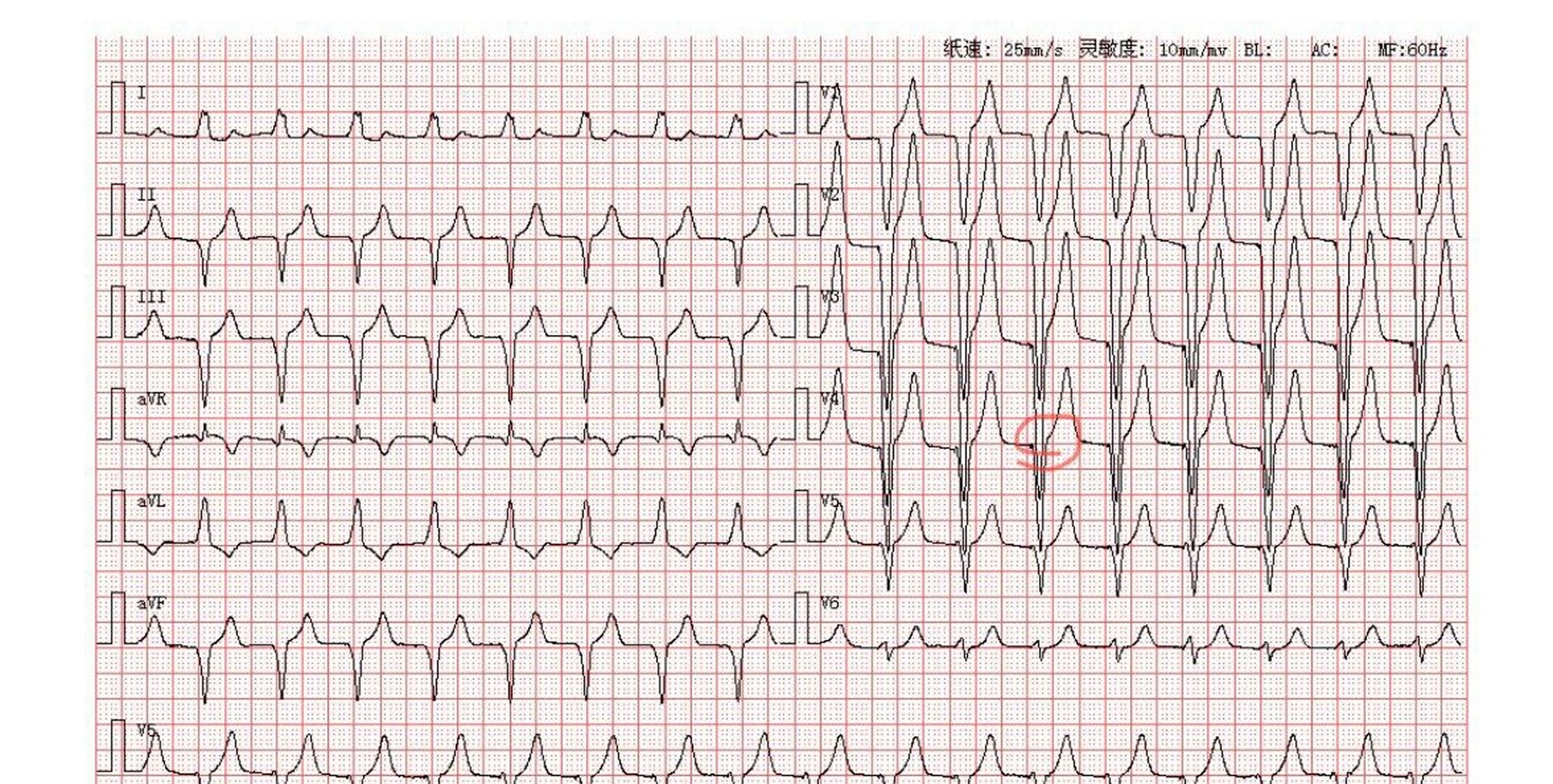 心室起搏心电图特点图片