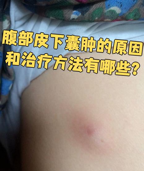 腹部皮下囊肿的原因和治疗方法有哪些?