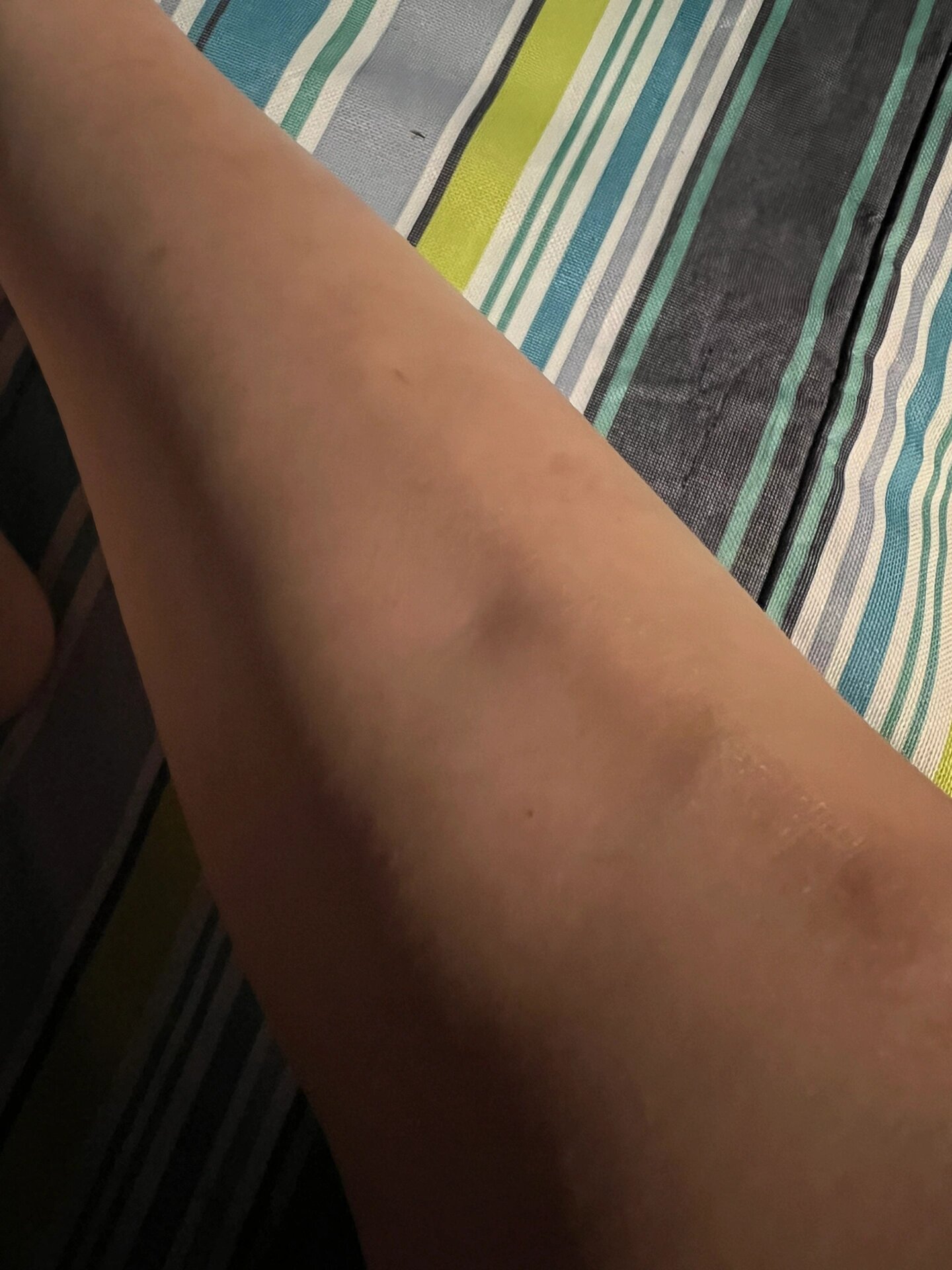 小腿上有个凹下去的坑 小腿前面的骨头有个凹洞,今天突然发现的,是