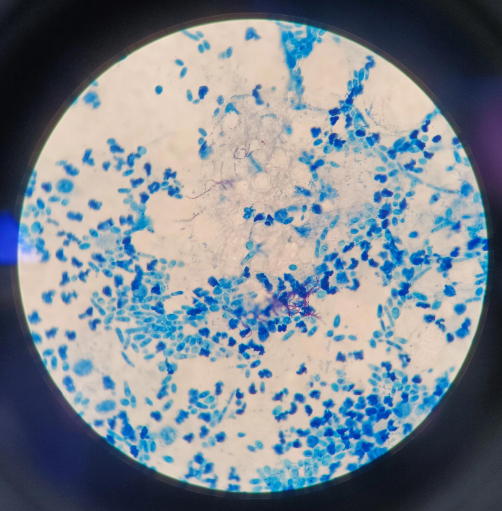 又遇见一例抗酸染色弱阳性细菌