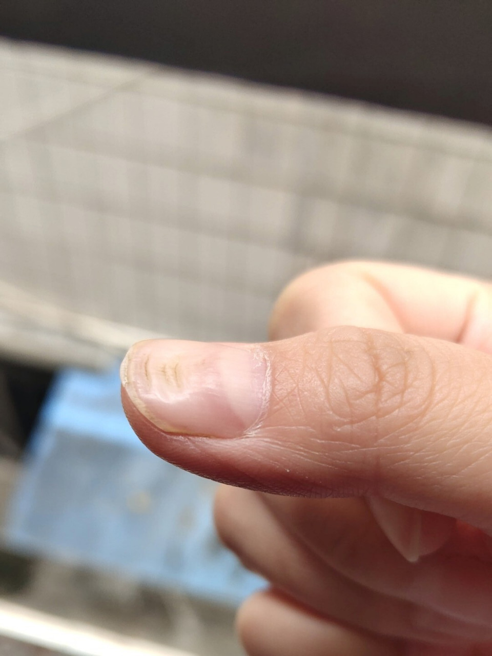 大拇指指甲凹陷图片图片