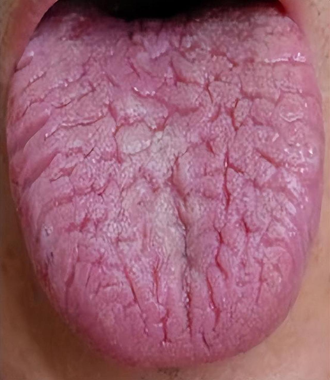 有没有朋友舌头中间是有裂纹的?