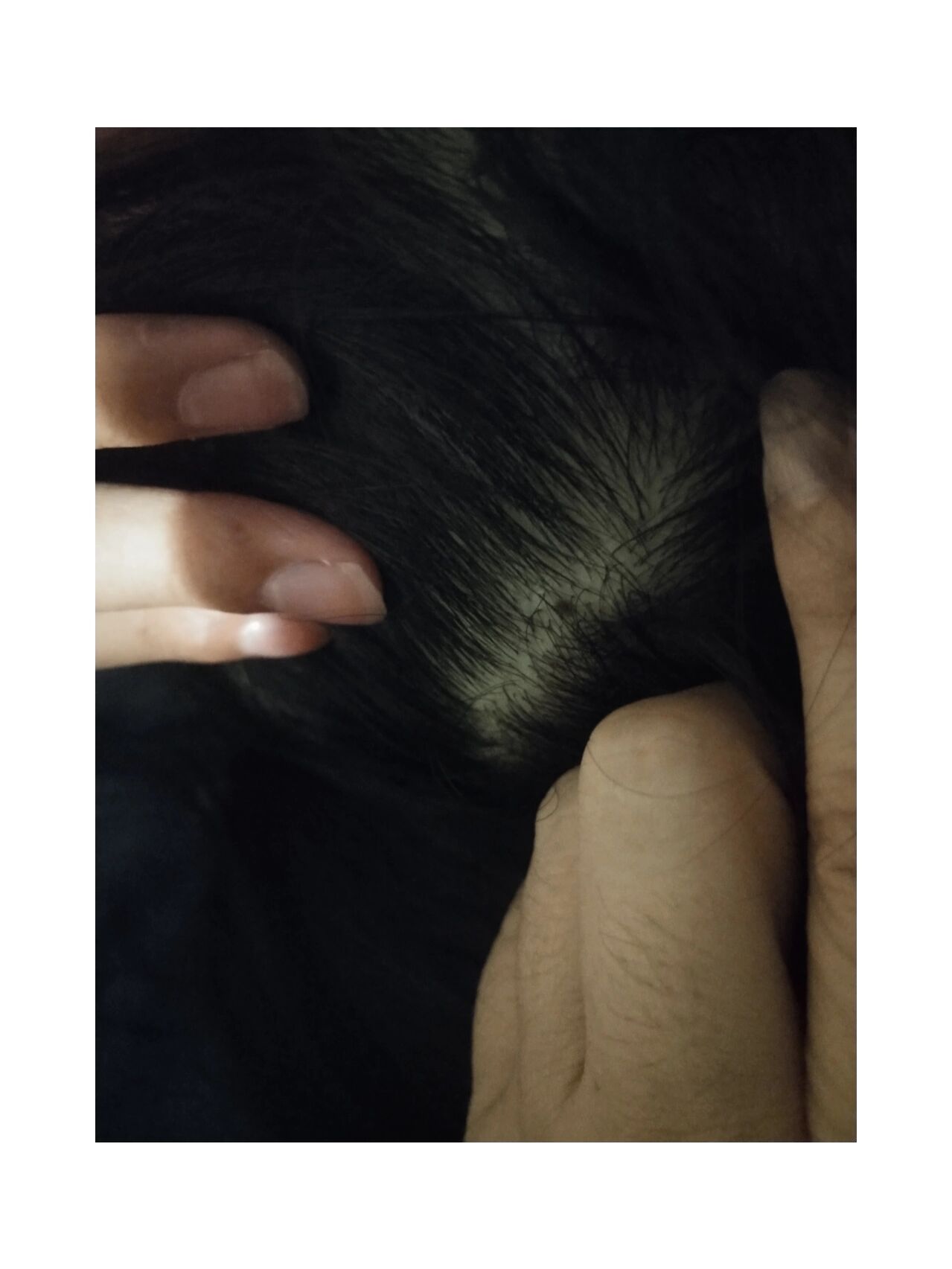 孩子头上有两颗这种痣,需要去点掉吗?