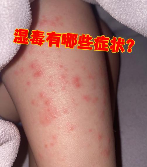 首先是皮肤瘙痒,这是湿毒最明显的表现