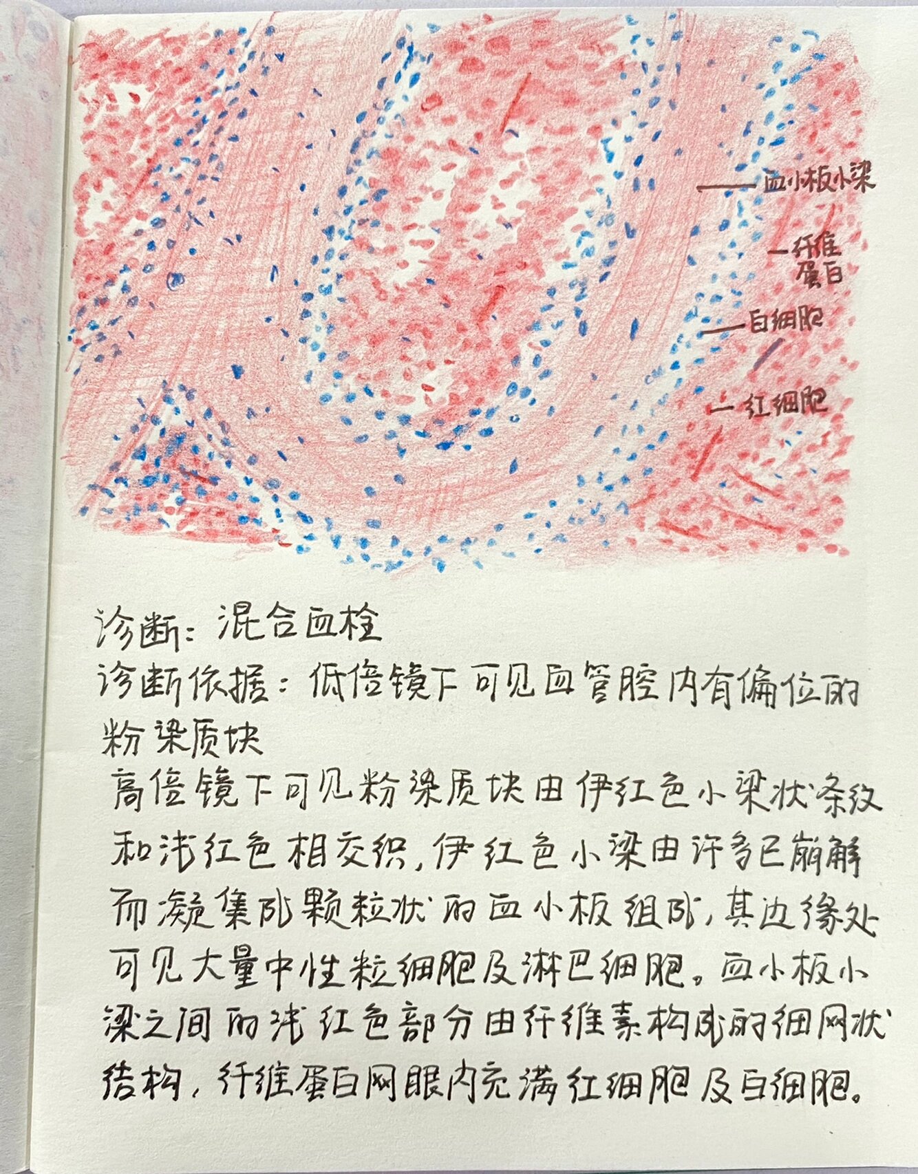 慢性肝淤血/慢性肺淤血/混合血栓 局部血液循环障碍及部分细胞变性(肝