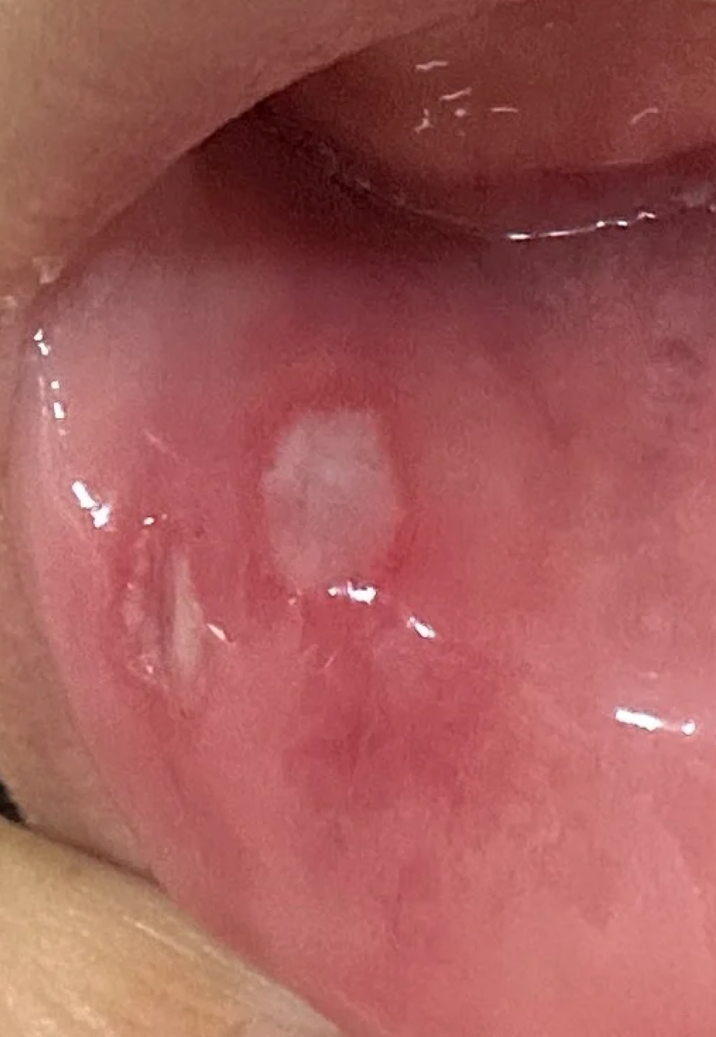 嘴巴经常长口腔溃疡是什么原因?