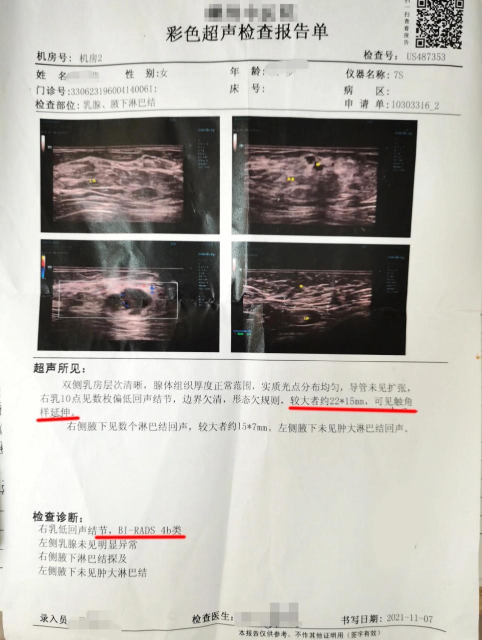 乳腺结节4b图片