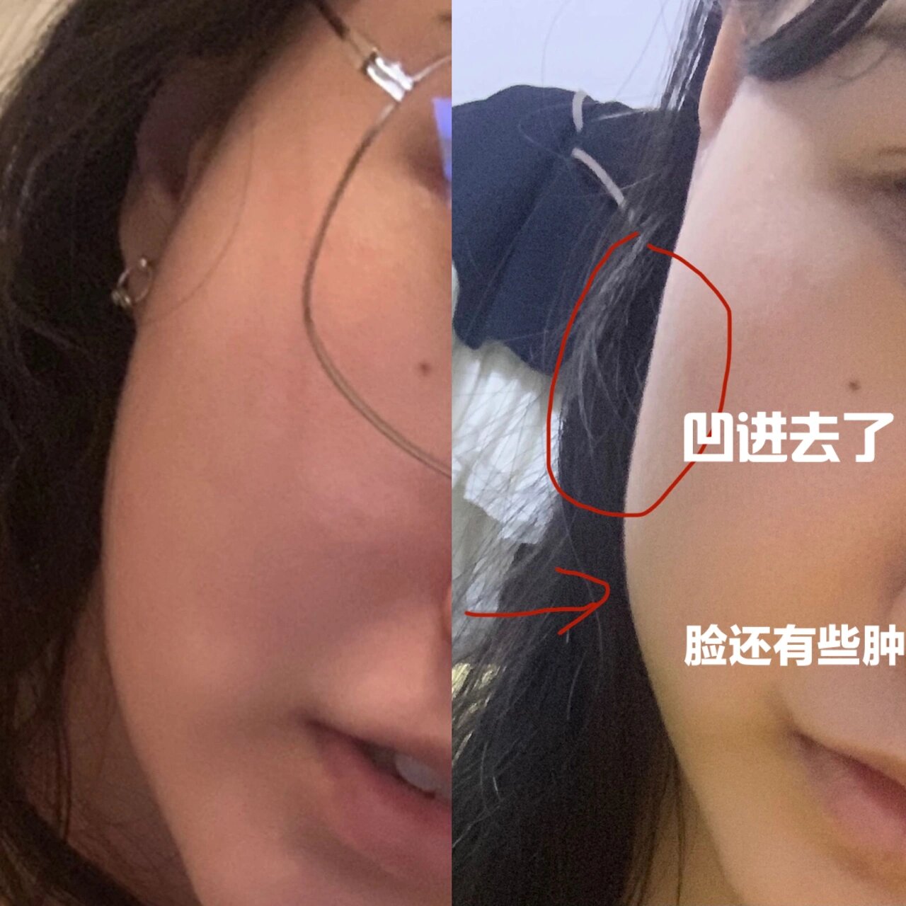 亲测拔智齿真的能瘦脸!对比图96
