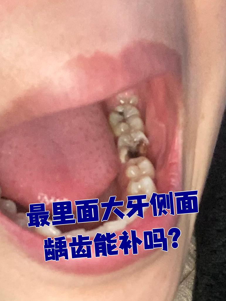 最里面大牙侧面龋齿能补吗?