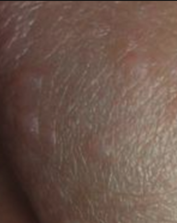 龟头红色丘疹可能和过度清洁,过敏,湿疹,真菌感染或性传播疾病有. 