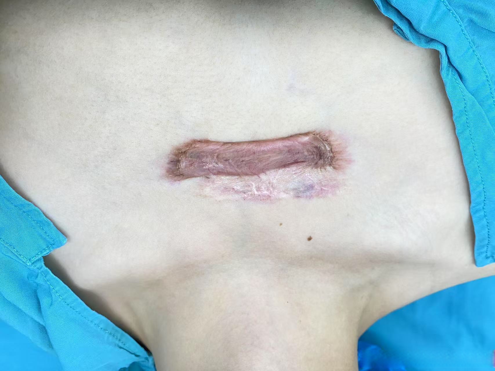 激光切黑痣后疤痕图片胸口刀疤图片乳房表皮增生的图片瘢痕疙瘩术前