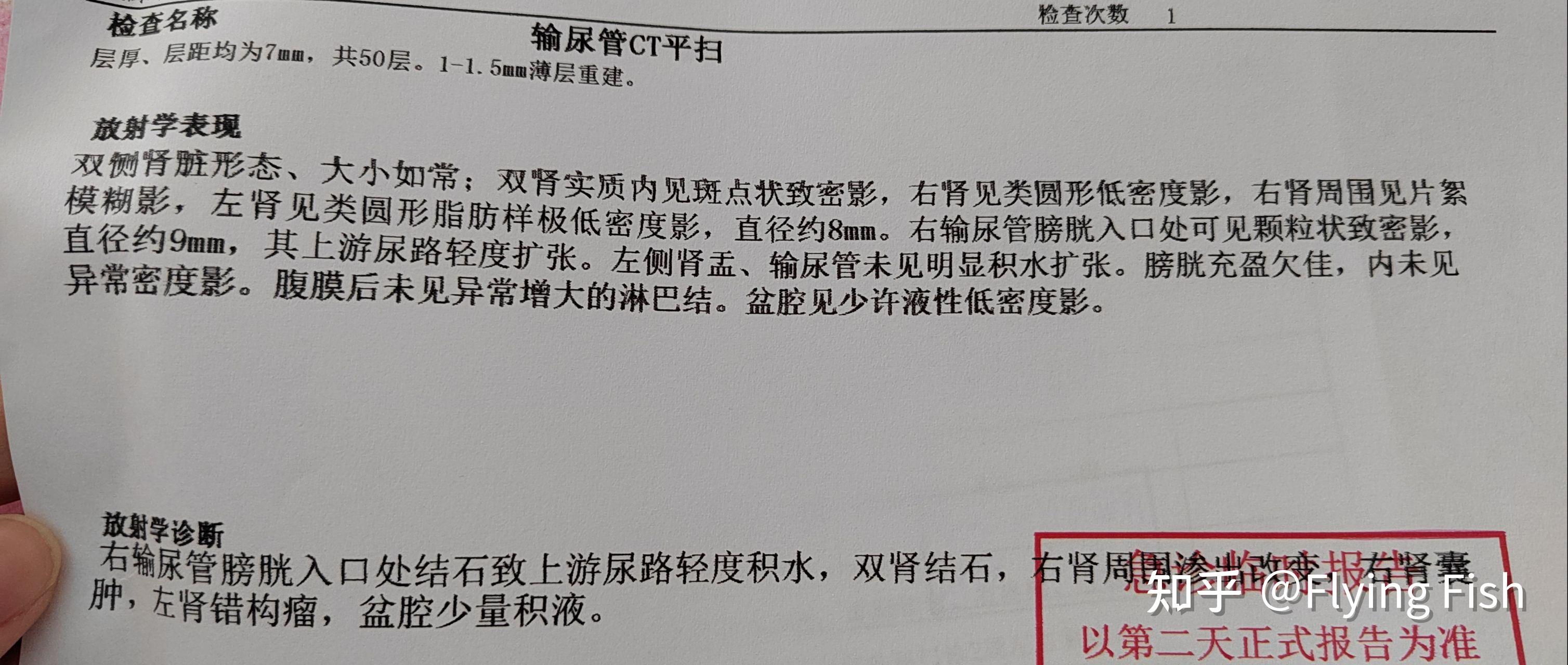 肾结石ct图片 报告图片