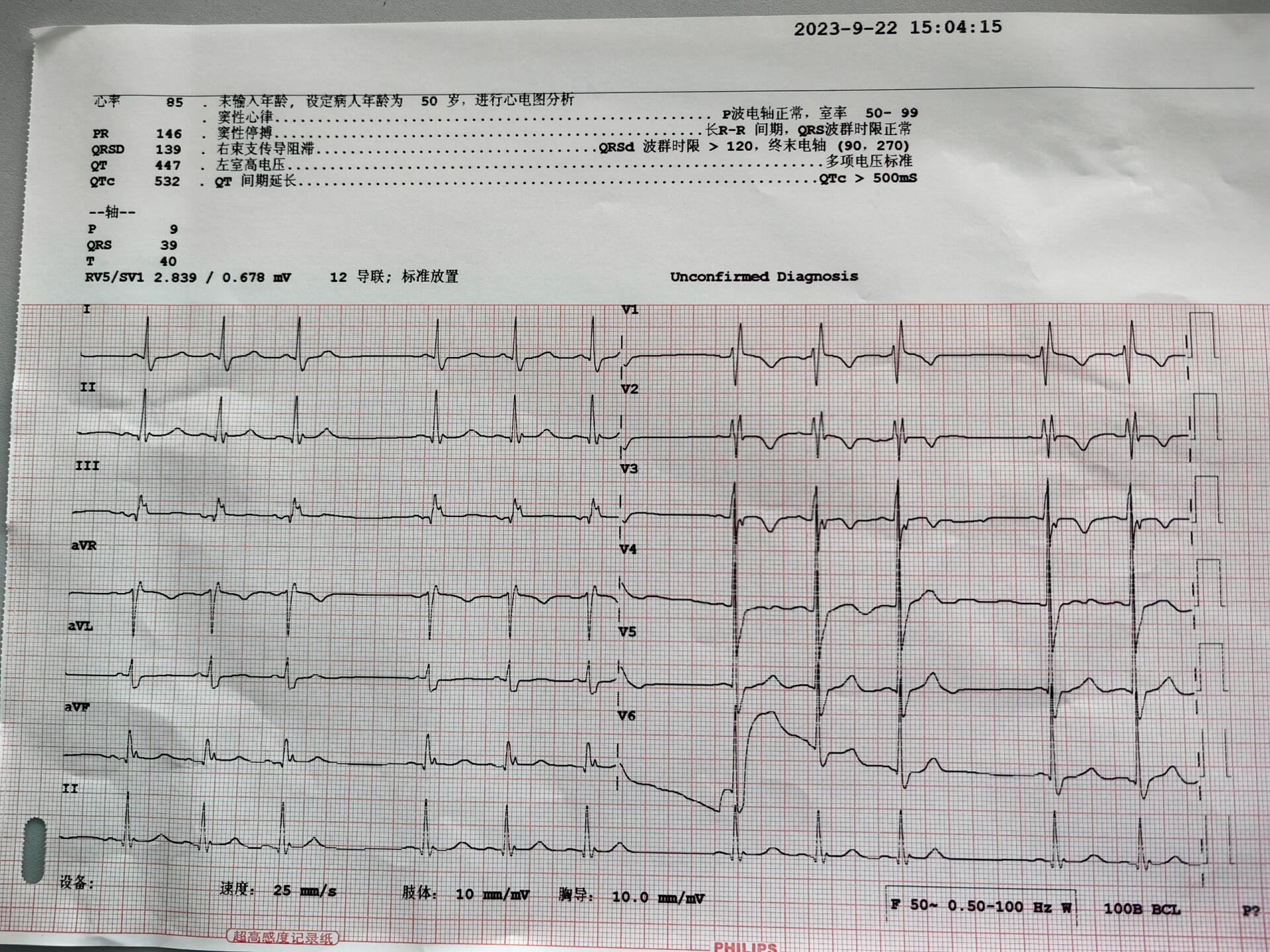 心电图思考 依然是上次(高度房室传导阻滞)病人. 窦性停搏?