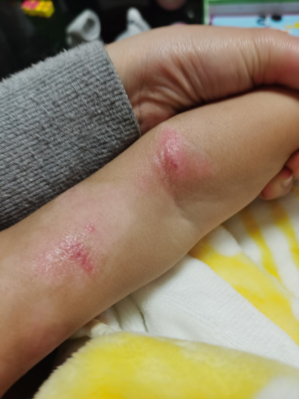 烫伤两个月 恢复后皮肤发白以后能变回来吗?