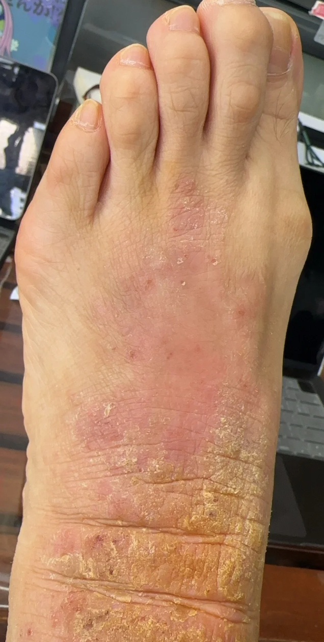 这很可能是足癣或湿疹引起的,两种病的处理方法不一样