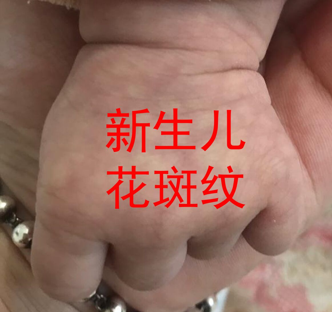新生儿花斑纹,不用紧张!