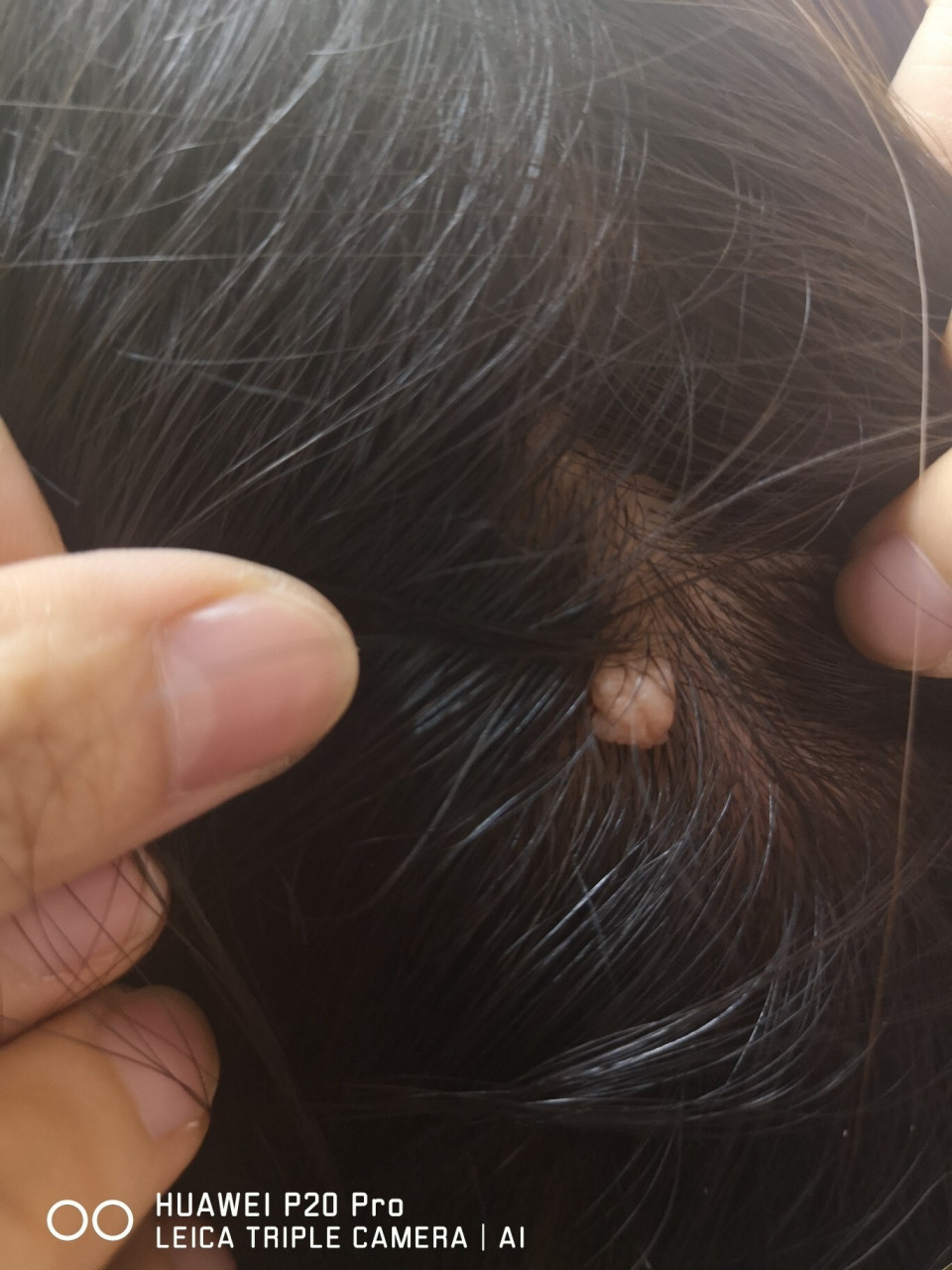十多年的大肉瘊去掉了 我们老家这个叫瘊子,长了好多年了,以前表面是