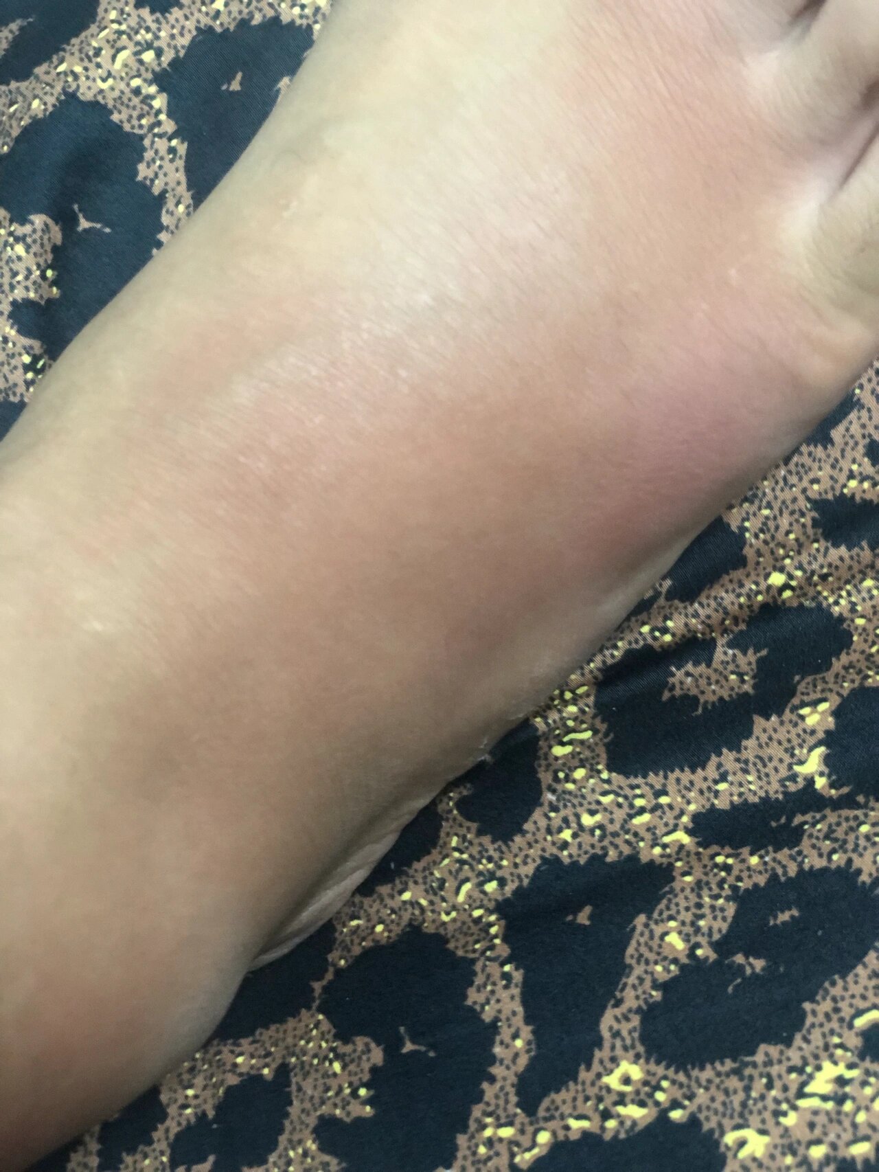 血管炎(结节性红斑) 3月起到现在反反复复,吃激素药就不长不痛,一断就