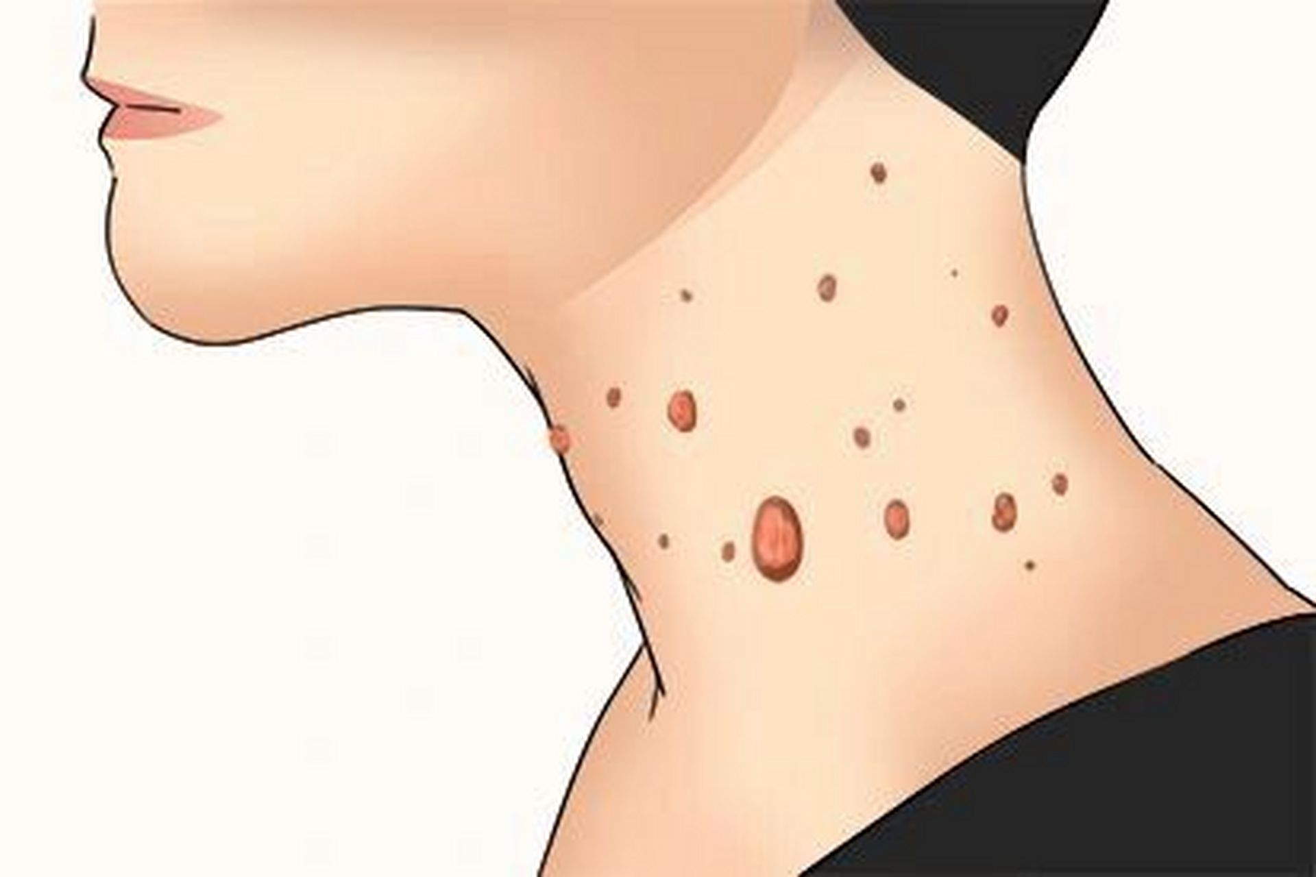 皮赘出现原因及预防 皮赘,也称作软垂疣,是一种非常常见的肉色带蒂的