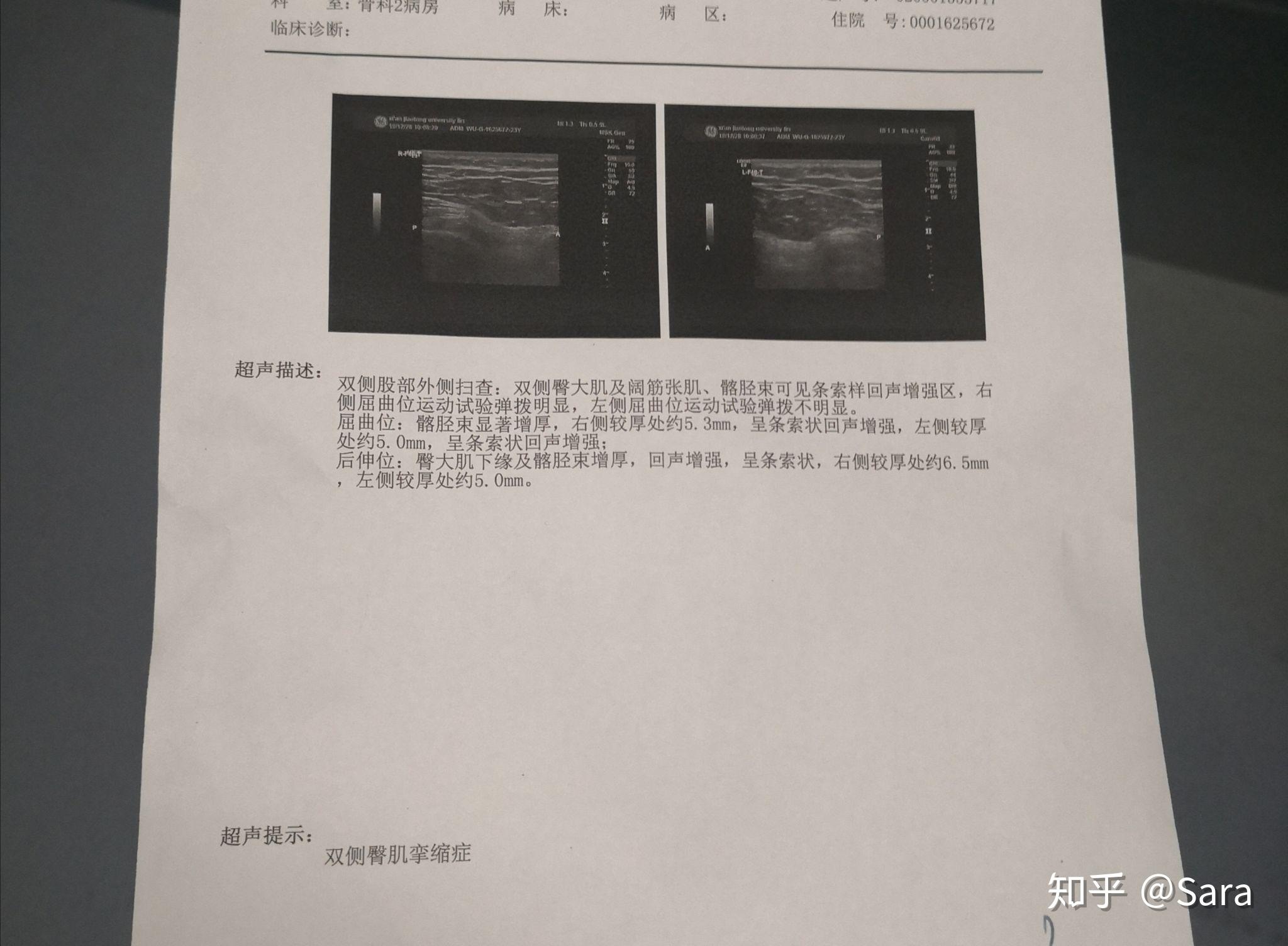 臀肌挛缩手术最佳年龄图片