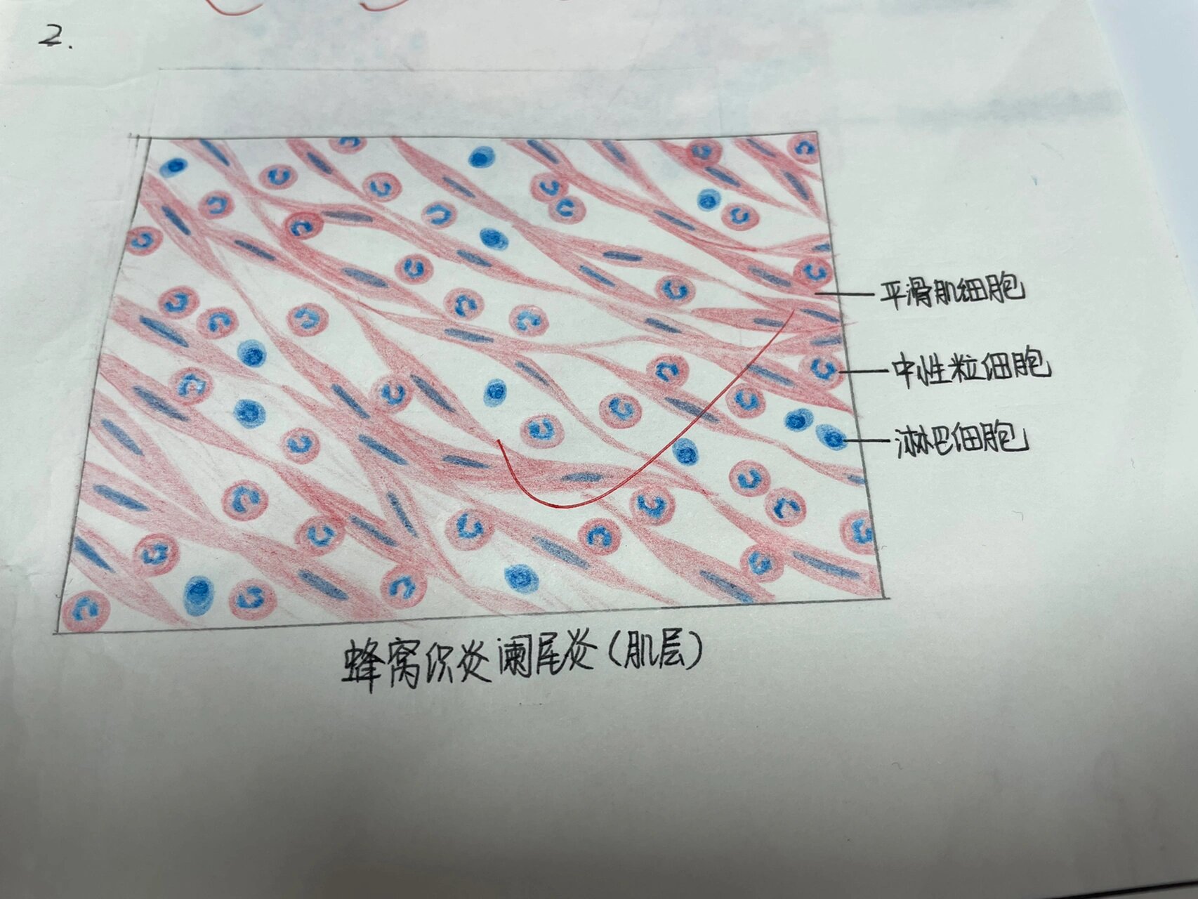 阑尾蜂窝织炎手绘图图片